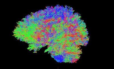 A diffusion weighted image shows the movement of water molecules within brain tissue. Courtesy: Mulva Clinic for the Neurosciences.