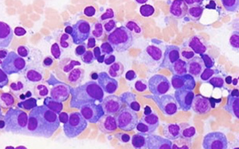 A microscope slide showing cells of multiple myeloma.